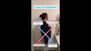 Upper and Lower Cross Syndrome [upl. by Imugem]