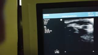 Enlarged Thymus Gland Ultrasound [upl. by Roana]