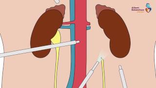 LAPAROSCOPISCHE NEFRECTOMIE Het verwijderen van een nier via een kijkoperatie [upl. by Narton518]