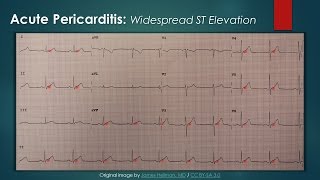 Acute Pericarditis ECG [upl. by Ayouqes]