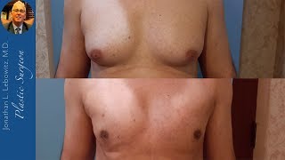 ONLY 1 MONTH PostOp❗Male VaserLipo Gynecomastia Surgery Long Island NY By Dr Lebowitz [upl. by Etka403]