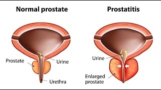 Prostatitis [upl. by Neeluqcaj483]