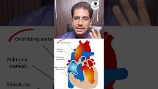 Tetralogy of Fallot TOF cardiology pediatrics shorts [upl. by Ateekal715]