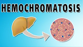 Hemochromatosis [upl. by Airotkiv]