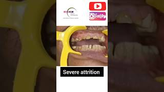 Management of severe attrition With Capping of teeth [upl. by Estis]