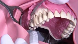 Periodontal surgery Modified Widmann flap [upl. by Thayne]