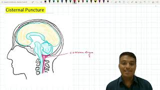 Cisternal Puncture  Suboccipital Puncture [upl. by Aliehs458]