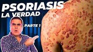 Qué es la Psoriasis 💔 Causas Complicaciones y Zonas ❤️‍🩹 Dra Natalia Merino  Dermatología [upl. by Samanthia]