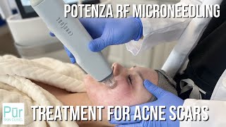 TREATMENT FOR ACNE SCARS  Potenza RF Microneedling in Edmonds WA  PUR Skin Clinic [upl. by Kaitlin]