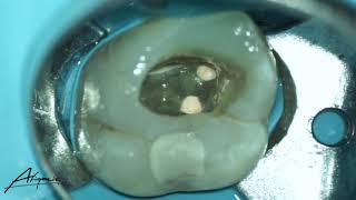 Obturation phase of the root canal treatment of maxillary second molar [upl. by Ativad396]