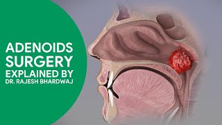 Adenoid Surgery By Dr Rajesh Bhardwaj  adenoidectomy sleepdisturbedbreathing coblation adenoids [upl. by Aserehs]