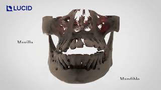 Maxilla amp Mandible Reconstruction with CustomMade Preprosthetic Subperiosteal Implants [upl. by Oniotna]