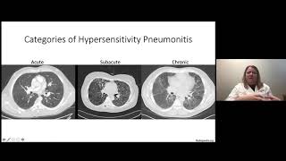 91 Granulomatous Lung Disease [upl. by Naujej]