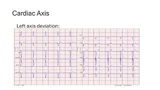 Cardiac Axis [upl. by Tnilf644]