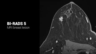 ACR BIRADS 5 lesion on MRI TheReportingRoom [upl. by Dadelos178]