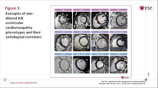 ESC 2023 Cardiomyopathies part 1 [upl. by Ahsela757]