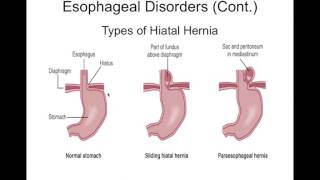 Chapter 36 Gastrointestinal Disorders BIOL300 [upl. by Schnabel]