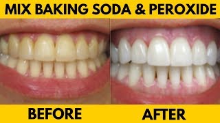 Hydrogen Peroxide Teeth Whitening  Mix Baking Soda amp Hydrogen Peroxide for Whiter Teeth [upl. by Tati]