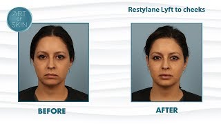 Restylane Lyft Perlane filler for cheek lifting and facial balancing [upl. by Anneyehc]