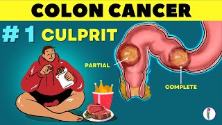 1 🔥 Cause of Colon Cancer amp how to prevent it  Colon Cancer  causes  Rectal cancer [upl. by Brey121]