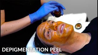 Depigmentation Peel  Melasma amp Hyperpigmentation Treatment  Live [upl. by Atteynad]