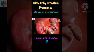 Slow Baby Growth in PregnancyRole Of Doppler Ultrasound baby preganacy doppler growth viral [upl. by Aernda]