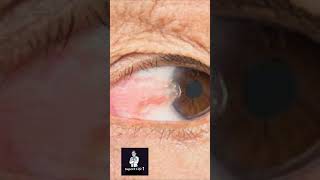 Pterygium [upl. by Saffren]