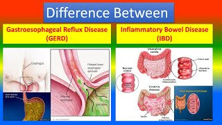 Difference between Gastroesophageal Reflux Disease GERD and Inflammatory Bowel Disease IBD [upl. by Idnac]