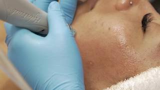 Hydrafacial Treatment and Deep Pore Cleaning [upl. by Barling390]