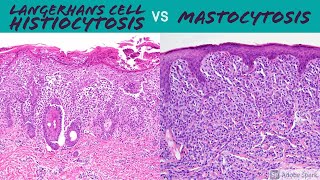 Langerhans Cell Histiocytosis vs Mastocytosis Hemepath for Dermatopathology Pathology Dermatology [upl. by Ilwain]