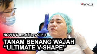 PROSEDUR TANAM BENANG ULTIMATE VSHAPE  NOVIS Dermatology Clinic [upl. by Ettenirt8]