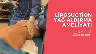 Liposakşın  Liposuction Yağ Aldırma Ameliyatı  OpDrTaner Bahar [upl. by Furiya]