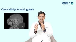 Cervical Myelomeningocele  Dr Dhananjaya I Bhat  Neurology  Aster RV [upl. by Eimia719]