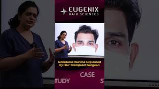 Unnatural Hairline Expert Analysis in Hindi  Eugenix Hair Sciences [upl. by Deegan]