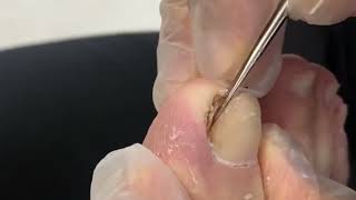 Ingrown Toenail  Impacted Toenail Removal  Toenail Fungus Treatment [upl. by Enelaj]