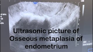 Ultrasound picture of Osseous metaplasia of endometrium [upl. by Acinot]