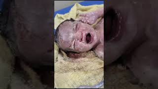 Covered with Lot of vernix and caseosa newborn baby have six fingers on hands [upl. by Anoiuq]