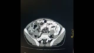 Ileocolic tuberculosis with fecalization of terminal ileum [upl. by Ria]