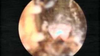 Revolix Laser Vap Resection of 130 CC Prostate [upl. by Dranyl139]