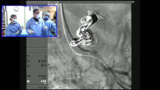 Celiac Artery Aneurysm Embolization using a Transradial Approach [upl. by Asiilanna431]