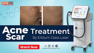 Acne scars treatment  Erbium glass laser  Frac Co2 Laser  Clear Skin Hair and Laser Centre [upl. by Roach]