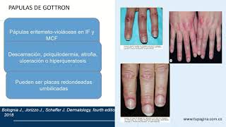 DITER  Módulo 7  Miopatías inflamatorias Epidemiología cuadro clínico y diagnóstico  01 [upl. by Keil464]