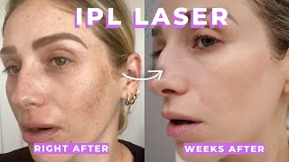 IPL  CLEAR AND BRILLIANT LASER REVIEW  What are they Are they painful Is it worth it [upl. by Zarihs660]