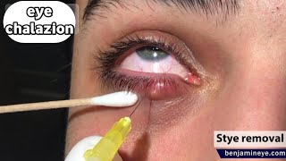 شاهد ازاي دمل العين بيتكون وازاي بنعالجةWhat is Chalazion [upl. by Kcirttap]