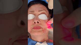 Endolift Jowls Treatment PCH MedSpa Los Angeles [upl. by Stephens]