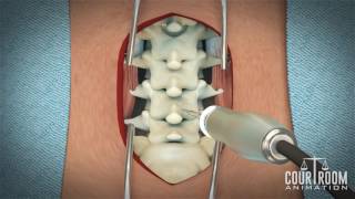 Lumbar Discectomy Surgery Medical Animation [upl. by Colwell]