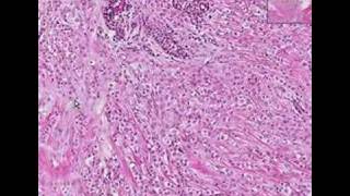 Histopathology BreastLobular carcinoma [upl. by Ikairik]